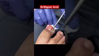 ENORMOUS INGROWN TOENAIL REMOVAL😮‍💨#shorts