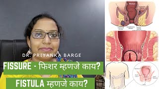 Fissure - फिशर म्हणजे काय? Fistula म्हणजे काय? फिशर साठी घरगुती उपाय | Dr. priyanka barge