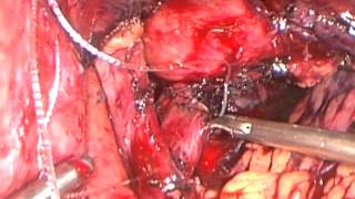 Laparoscopic Revision of Roux-en-Y Gastric Bypass and Hiatal Hernia Repair