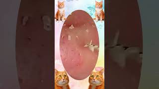 Blackheads Removal | Acne Treatment and Very Satisfying Satisfying Pimple pop #blackheads