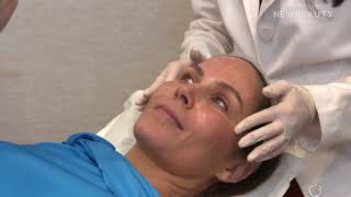 Vampire Facial Microneedling w /PRP  | NewBeauty | NYC