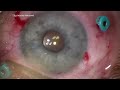 iol exchange surgery with open capsule after yag capsulotomy dr simon chen