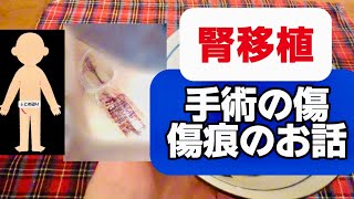 【腎移植】手術の傷・傷痕のお話