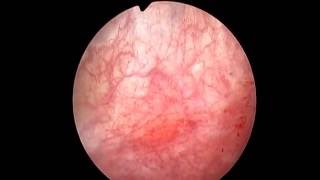 Glomerular bleedings during hydrodistension of the bladder and several spiral vessels