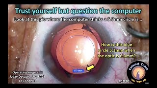 CataractCoach™1830: trust yourself but question the computer