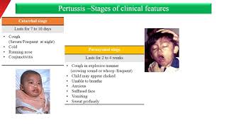Pertussis-Whooping cough