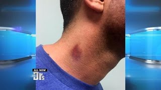 What the Health?! Can Hickeys Kill?