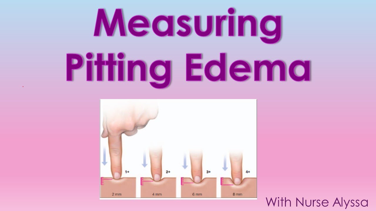 How To Measure Pitting Edema - YouTube