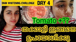 Day 4||തക്കാളി മതി ചുണ്ടിനും കഴുത്തിനും ചുറ്റുമുള്ള കറുപ്പ് മാറ്റാൻ||Skin whitening challenge!!!