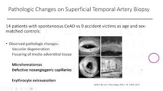 Carotid Artery Dissection: New Insights and Continued Controversies