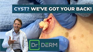 Cyst? We've Got Your Back! | Dr. Derm