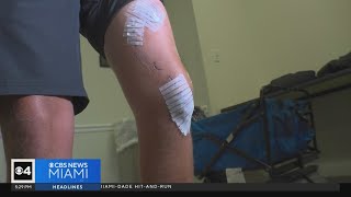 Florida man who was bitten by two sharks in The Bahamas lives to tell his story