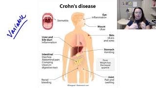 Crohns Disease