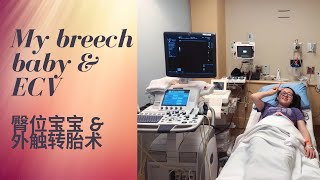 【Ninarrr】我的臀位宝宝和外触转胎术 - 调整胎位 （新手妈妈） | My breech baby and experience with ECV (first time mom)