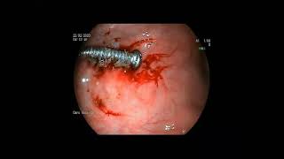 Foreign Body removal through endoscopy # Gastro #  Dr Gursewak Singh ( DM Gastro ,PGI Chandigarh )