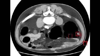 Algorithm : intestinal polyps search