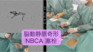 NBCAによる脳動静脈奇形の塞栓