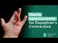 Needle Aponeurotomy for Dupuytren's Contracture