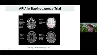 Will Aducanumab Be The Next Treatment for Alzheimer's Disease