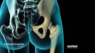 Total Hip Replacement Surgical Procedure | Top Orthopaedic Hospital In India | Manipal Hospitals