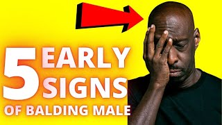 Symptoms of Hair Loss in Men - Early Signs of Balding Male
