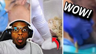 These TikTok Cyst Explosions Are ABSOLUTELY INSANE!