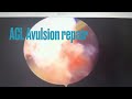 ACL Avulsion repair by Dr Rohit Damor(Arthroscopy,Sports injury & Arthroplasty surgeon)