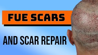 FUE Scars and Scar Repair - Hair Transplant Results and Procedures