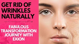 Story of My EXION Treatment for Skin Tightening and Wrinkle Reduction!