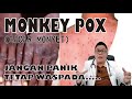 CACAR MONYET (MONKEY POX), DEFINISI, GEJALA & TANDA, PENULARAN,  PENGOBATAN DAN PENCEGAHAN