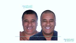 Timmi confidently smile again - Dental Implants Perth - My Implant Dentist