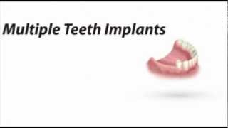 Multiple Teeth Implant - Dr. Ernest Cholakis