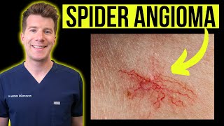 Doctor explains SPIDER ANGIOMA (aka spider nevus/telangiectasia) | Causes, photos, treatments