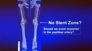 Popliteal Artery Lesions: How I Decide Between Atherectomy Stenting or Bypass