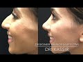 designer rhinoplasty tm