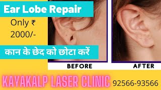 Ear Lobe Repair by Pasting / Ear hole Repair कान का छेद छोटा / Ear pasting / Ear lobe repair