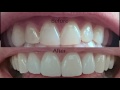 dental veneers procedure overview