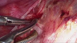 LAPAROSCOPIC NEO-VAGINOPLASTY