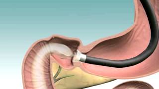 Wie der Duodeno-Jejunale Bypass-Implantat entfernt wird