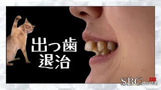 「超出っ歯」をセラミックで改善