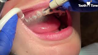 Should I Visit My Dentist While I Wear Braces? Dental cleaning with braces  Tooth Time New Braunfels