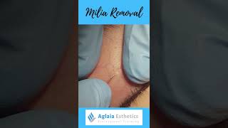 MILIA REMOVAL DEMOSTRATION #SHORTS