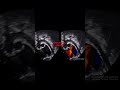 Modified Subcostal Echo View #echocardiography #pediatriccardiology #echocardiogram