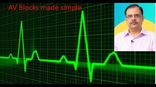 Understanding AV blocks | ECG made simple | medicine concepts