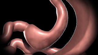 Sleeve Gastrectomy Animation