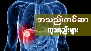 အသည်းကင်ဆာ ကုသနည်းများ (Liver Cancer)