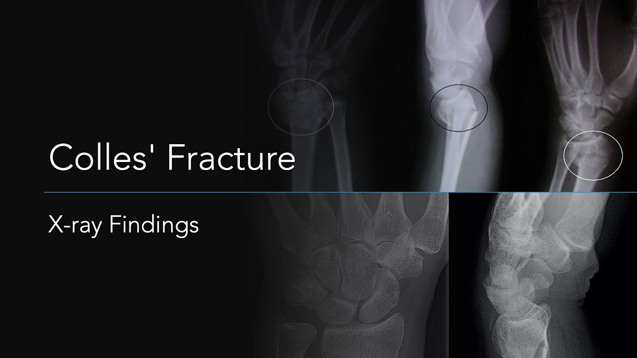 Smith Fracture Vs Colles Fracture Galeazzi Fracture