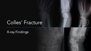 Colles' Fracture: X-ray Findings