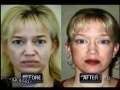 Stem Cell Face Lift Done Right By Dr. Renato Calabria