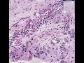 histopathology brain mucormycosis meningoencephalitis